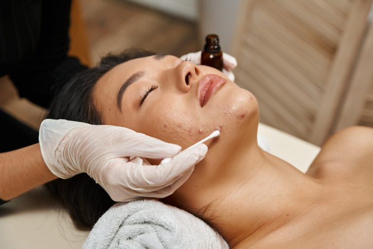 Trị mụn không xâm lấn